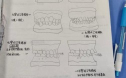 正畸安氏三类分型