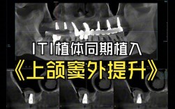 什么是种牙外提升手术？视频详解关键操作步骤