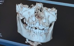 矫正牙拍牙齿ct