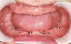 暨大穗华口腔种牙好不好？效果和价格怎么样？