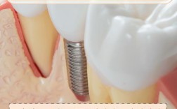 不种牙比种牙强