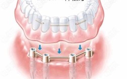 allon4种牙成功率怎样？影响因素有哪些？