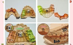 国产MBT正畸托槽效果如何？质量可靠吗？性价比高吗？