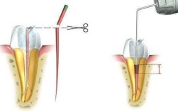 根管测定工作长度的方法