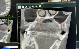 种牙离上额窦近，会有风险吗？需注意什么？