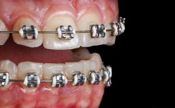 金属牙齿矫正图片