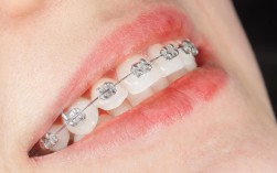 自锁牙齿矫正器图片