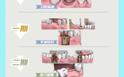 种牙是怎么种的？种植过程有哪些步骤？