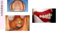 无牙颌口底封闭方法关键临床操作步骤与效果如何？