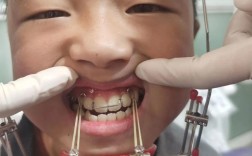 地包天微创正畸