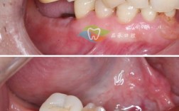 种牙失败通常会出现哪些异常症状？如何准确判断种植牙是否真的失败了？