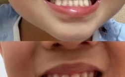 地包天正畸拔上牙