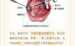 麻醉牙齿的方法有哪些常见类型及适用？