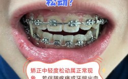 矫正期间牙齿松动怎么办？会影响最终矫正效果吗？