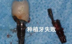 种植牙失败的影响
