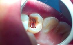 根管侧穿后如何科学补救？不同补救方法的适用场景与成功率解析