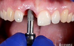 种植牙手术区域旁放置失活剂是出于什么临床考量？是否存在邻牙误伤或感染风险？