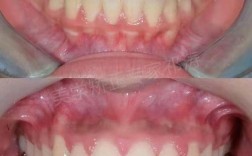 矫正后牙齿无法咬合？原因是什么？