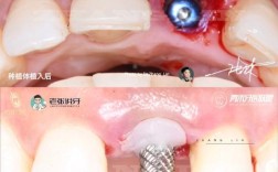 牙前区种植修复效果如何？关键技术与注意事项有哪些？