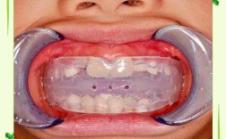 功能诱导与正畸治疗，如何选择早期矫治方案？