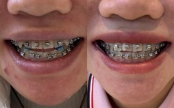 虎牙矫正最快方法是什么？哪种方式最快速？