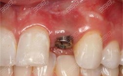 诺贝尔种植牙为何要一万？价格是否虚高？