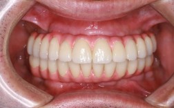 种牙费用是一次性交清还是可分期？支付方式有几种选择？