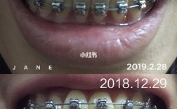 牙齿正畸期间更换钢丝的次数究竟由什么决定？是固定次数还是因牙齿矫正阶段、个体差异而变化？