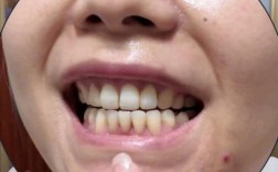 正畸后一颗尖牙老不动