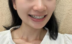 正畸 结束后照片