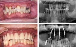 北京种牙哪种比较好？种植体品牌、材料如何选？