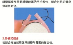 口腔缝合常用方法有哪些？不同伤口如何选择技巧？