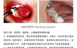 拜博口腔儿童窝沟封闭，真能有效预防儿童蛀牙吗？