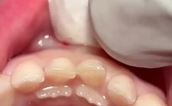 不同乳牙拔除方法有何差异？如何正确选择与操作？