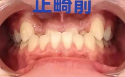 骨性正畸效果究竟如何？真实疗效深度解析