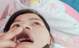 即拔即种牙手术疼不疼？真实感受到底如何？