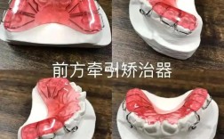 正畸前方牵引器图片展示了哪些佩戴和使用要点？