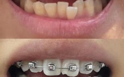 蛀牙多有必要正畸吗