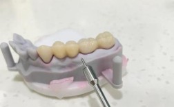 牙齿正畸一定要打钉