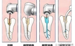 后牙拔髓的具体操作步骤有哪些？不同根管形态下使用方法有何注意事项？