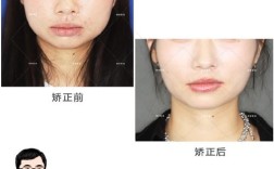 深圳矫正牙齿贵吗