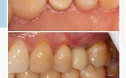 拔牙半年后种牙