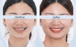 牙齿稀疏缝大矫正后，缝隙能完全消失吗？