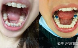 正畸牙弄的白色垫高
