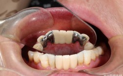 老年缺牙 镶牙 种牙