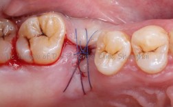 种牙后为何要缝线？对恢复有影响吗？