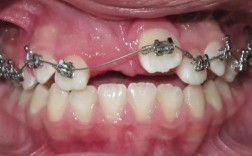 埋伏牙正畸恢复期有哪些护理要点需注意？