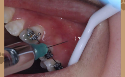 隐适美牙齿正畸拔牙