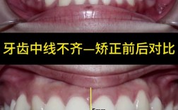 正畸调中线有哪些方法？如何精准调整与保持效果？