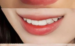 30岁正畸效果怎么样